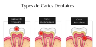 découvrez combien de temps met une carie à s'aggraver et comment prévenir son évolution avec des conseils dentaires efficaces.