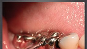 découvrez les conseils du dentiste pour enlever et remettre un bridge dentaire en toute sécurité, afin de préserver votre santé bucco-dentaire.